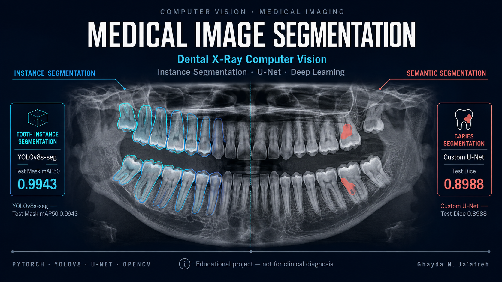 Medical image segmentation dental X-ray project cover